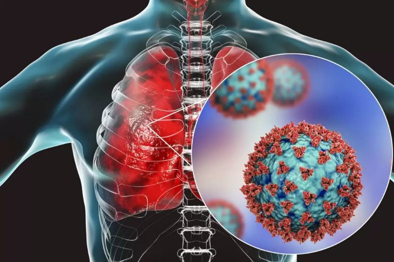 Вирус пневмонии картинки